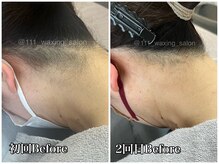 トリプルワン(111)/うなじワックス脱毛【1ヶ月後】