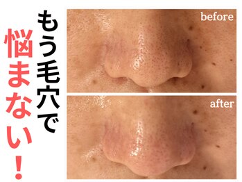 エリン(ERIN)/毛穴徹底洗浄×レチノールピール