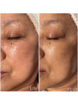 楚々(SOSO)/before after 3回目