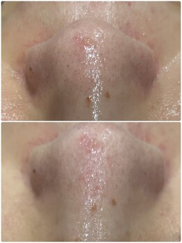 トータルビューティーサロン ヴィヴィエ(ViVier)/ハイドロフェイシャル症例1回