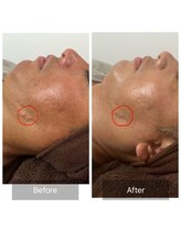 デイジー/グリーンピール（1g）/ニキビ