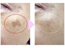 ノンノン(NonNon)の雰囲気（塗るだけで実感。自宅で叶う。シミ改善。）