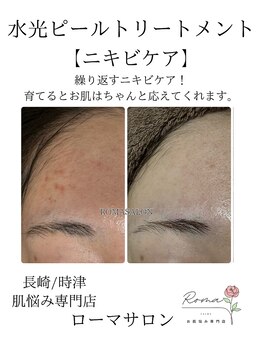 ローマサロン/根本肌質改善♪ニキビケア