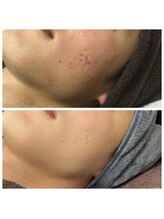 リラーナ(Re rana)/メンズニキビケア♪