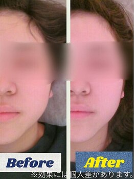 マカナ整体サロン 名駅(MAKANA)/小顔調整 Before→After