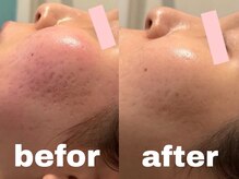 クインティナ(Quintina)/ハーブピーリング