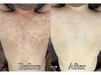 ココティー 大阪店(Cocotii)/男性 背中5回のケア変化