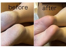 シンリーネイル(sinly nail.)/フットかかと角質ケア