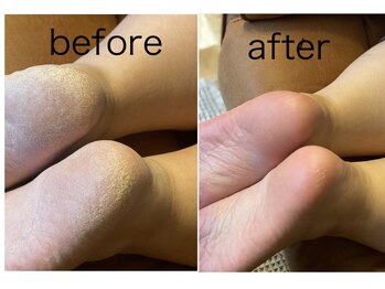 シンリーネイル(sinly nail.)/フットかかと角質ケア