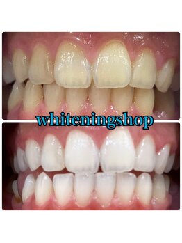 ホワイトニングショップ 盛岡店(WHITENINGSHOP)/学生の方も歯が命★