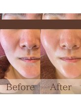 凪眠/小顔リンパフェイシャルの効果3