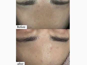 アワピール 成田公津の杜店(AWA PEELL)/ハーブピーリングでツヤ肌