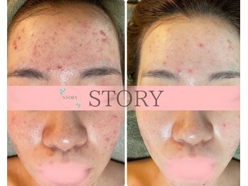 ストーリー(STORY)/ハーブピーリング専門店STORY