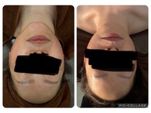 クオーレ(cuore)/レモンボトルビフォーアフター