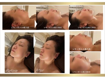 サロンフィーユ(Fille)/レモンボトル導入1~3回