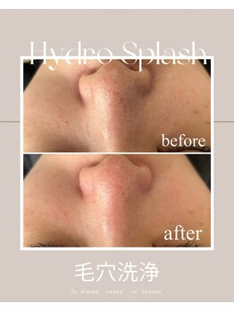 ジュメーム サンテ エ ボーテ(Je m'aime sante' et beaute')/ハイドロ毛穴洗浄