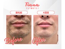 ティアナ 豊橋店(Tiana)/【ヒゲ脱毛】Before☆After