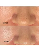 エムアンドユウ(m&u)/初めての毛穴洗浄