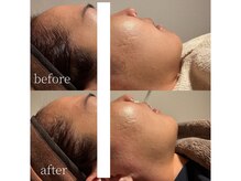 コモレビ(komorebi)/町田/フェイスワックス/顔脱毛