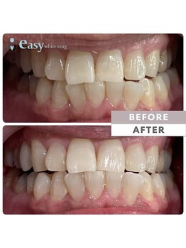 イージーホワイトニング 神戸三宮店(easy whitening)/お客様の症例写真です★