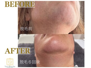 ヴェールブランシュ 町田(Vert Blanche)/#ブライダルエステ#脱毛#毛穴