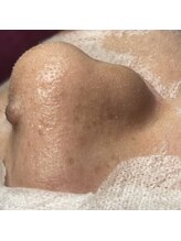 ビエン(bien)/お鼻だけじゃない！全顔ツルツル