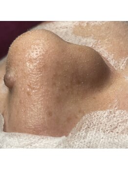 ビエン(bien)/お鼻だけじゃない！全顔ツルツル