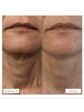 ラキネイ 目黒(Lakinei)/「しわ」「たるみ」即効効果◎！