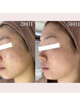 ホワイトアクア 福岡天神店(WHITE AQUA)/ハーブピーリングビフォー