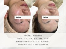 エメ 名古屋栄店(aimer)/SkinCare <肌管理・エイジング>