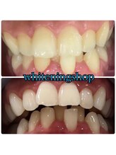 ホワイトニングショップ 豊橋店(WHITENING SHOP)/Before&After豊橋ホワイトニング