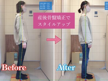 つくし鍼灸接骨院/20代/産後骨盤矯正