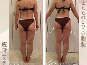 ラナ(LaNa)/40代からの痩身エステ