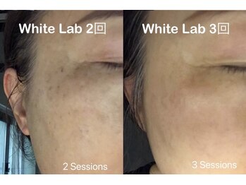 三美創ビューティースタジオ 富山店/シミ改善にホワイトラボ