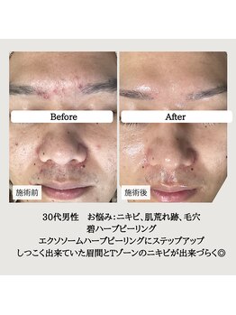 ル ボヌール 伊那店(le bonheur)/しつこいニキビも
