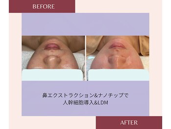 ジーンバイピエル 中野店(gene by PIEL)の写真/【韓国肌管理/小顔】むくみ・赤み・水分乱れを整え別人級小顔へ【水玉リフティング/中野/高円寺/新宿】
