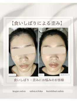 イチカ 仙川店( ichika)/食いしばりによる左右差