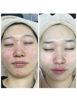 アウレア 辻堂(aulea)/ハーブピーリングbefore→after