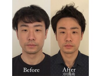 コルミチョン サロン(骨美整 salon)/Before・After &nbsp;3回施術