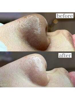 ライカブルー(RaicA BluE)/施術写真　before-after