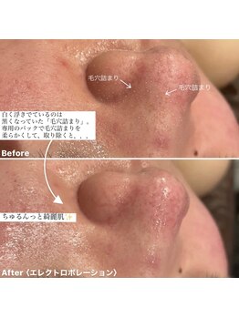 ミエル 神戸店(Miel)/毛穴洗浄はプロにお任せを!