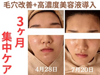 エリン(ERIN)/毛穴徹底洗浄