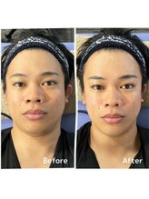おおむら鍼灸接骨院/フェイシャル Before＆After