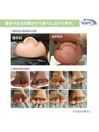 巻き爪専用ジェルネイル