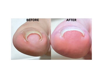 【巻き爪】フットケア大阪