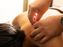 ベアーズ接骨院 鍼灸院 大宮七里店/鍼灸1