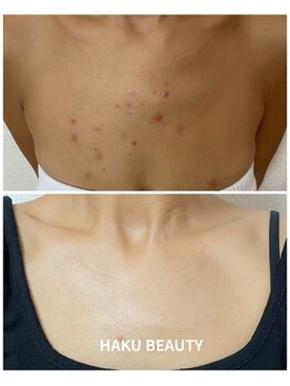 ハクビューティー(HAKU BEAUTY)/デコルテケア/ニキビ