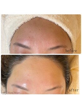 ブラン ネージュ(Blanc Neige)/レストセルトリートメント