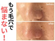 エリン(ERIN)/毛穴徹底洗浄×マイクロニードル