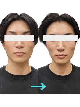 レベンディス(LEVENDIS)/小顔リフトアップ